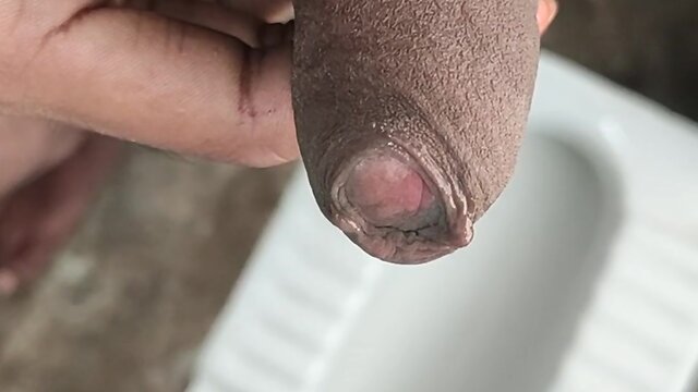 Penis peyronies and phimosis: an overview